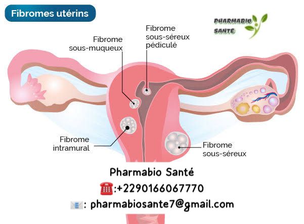 Fibrome et Grossesse