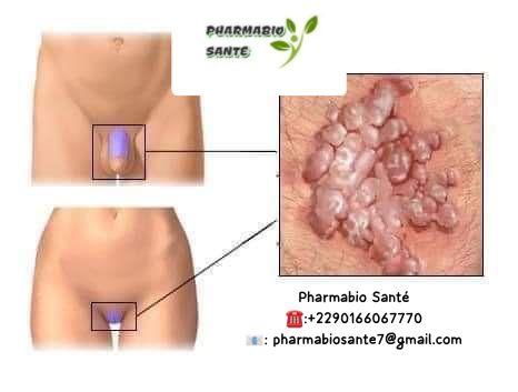 Condylome Fertilite Grossesse