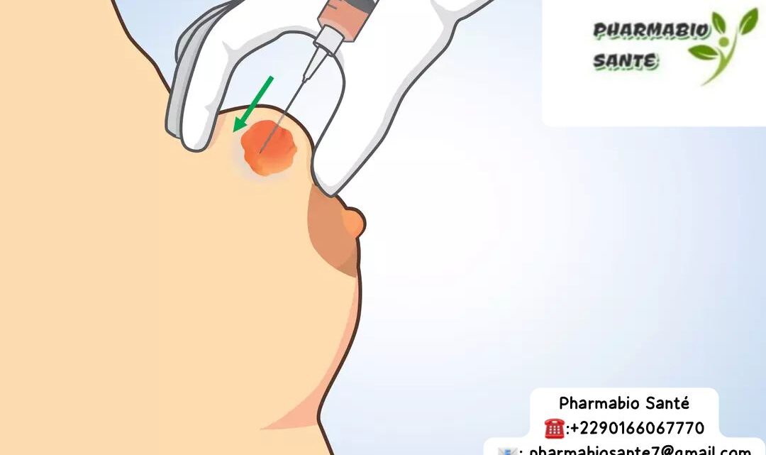 kystes mammaires remèdes naturels