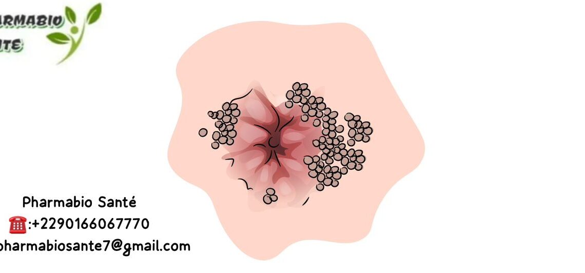 Traitement naturel condylome