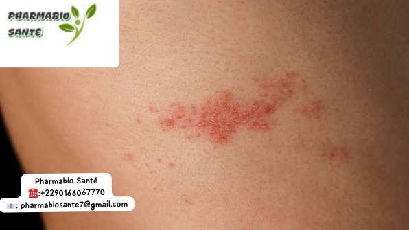 Traitement Naturel Varicelle Zona