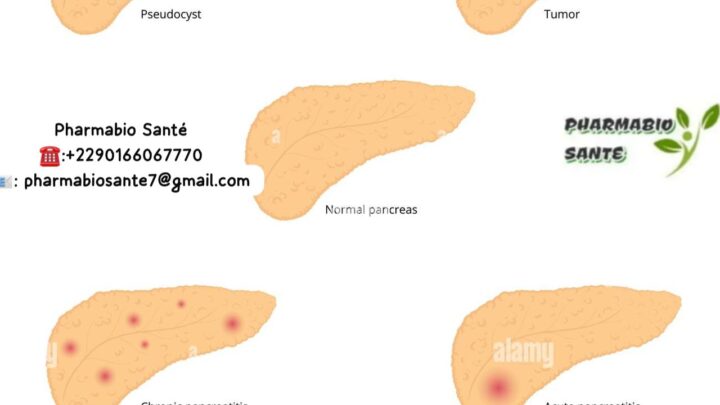 Kystes du foie remèdes naturels