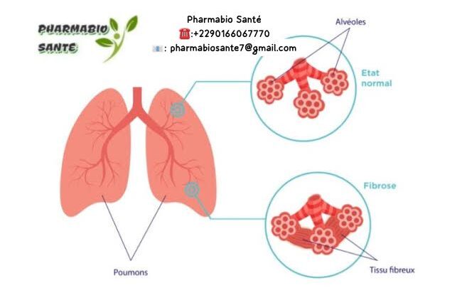 Fibrose Pulmonaire Traitement Naturel