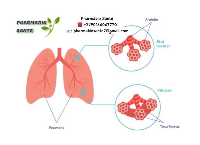 Fibrose Pulmonaire Traitement Naturel