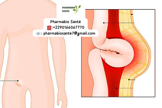 Hernie Crurale traitement naturel