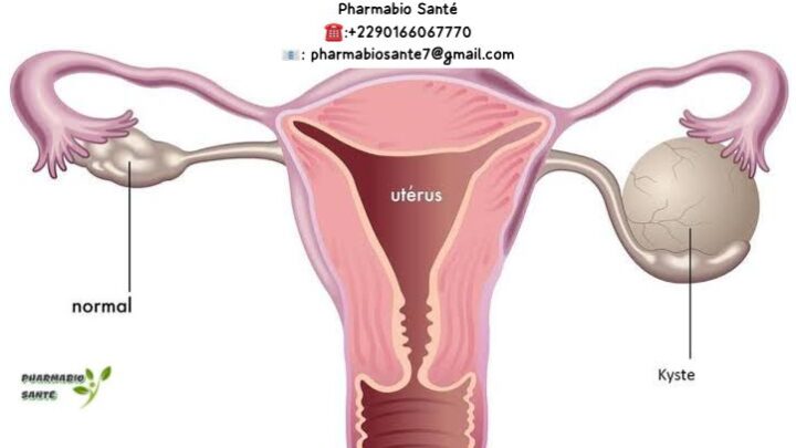 tisanes kystes ovariens