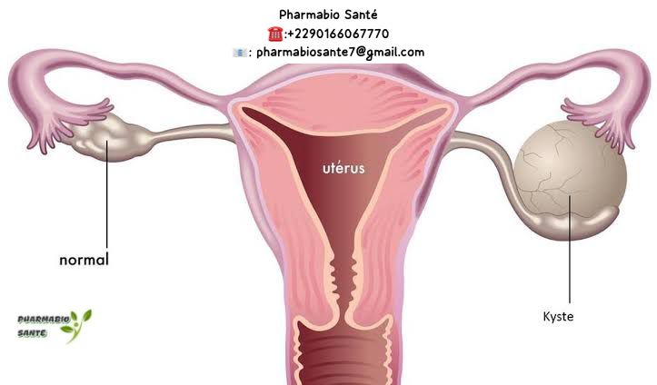tisanes kystes ovariens