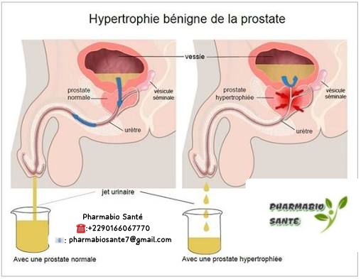 Kystes de la prostate remèdes naturels