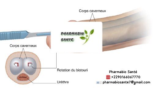 Priapisme Causes Traitement Naturel