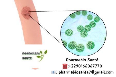 Alimentation condylome HPV