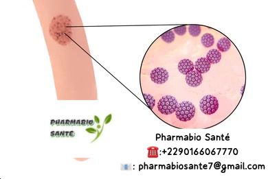 Condylome plat condylome acuminé
