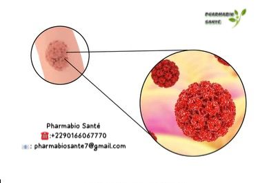 Symptômes condylome