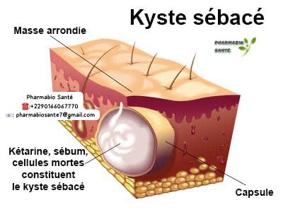 kystes sébacés remèdes naturels