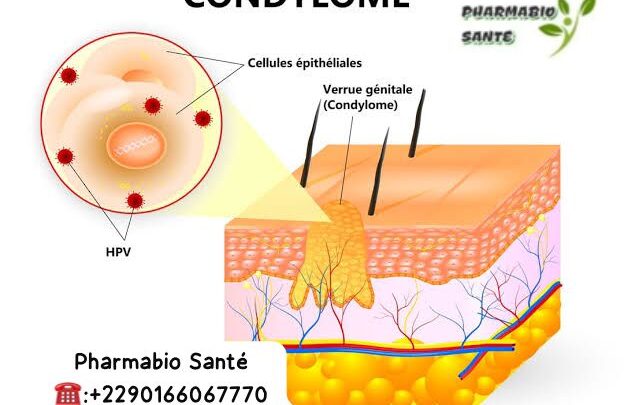 Huiles essentielles condylome