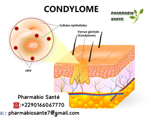 Huiles essentielles condylome
