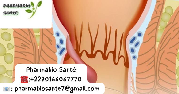 Condylome anal vaginal pénien