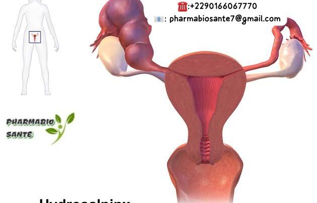 Hydrosalpinx Solutions Naturelles