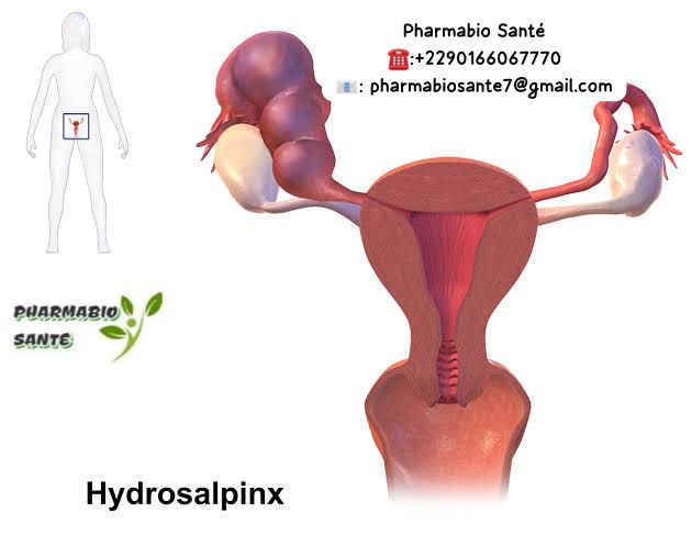 Hydrosalpinx Solutions Naturelles
