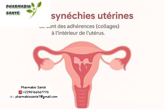 Synéchie Utérine Traitement Naturel Plantes