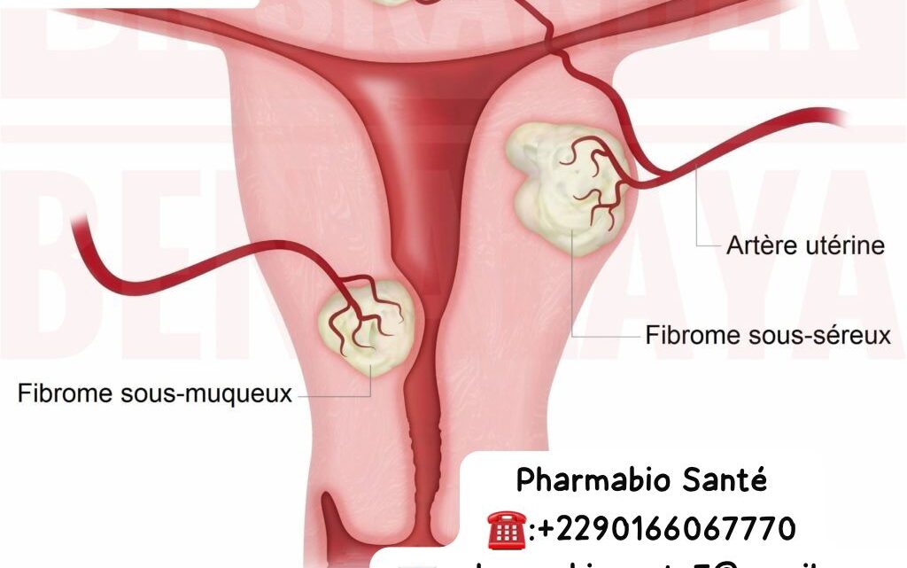Fibrome Utérin Plantes et Ail