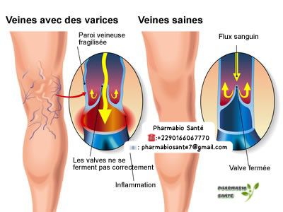 Plantes pour traiter l’insuffisance veineuse