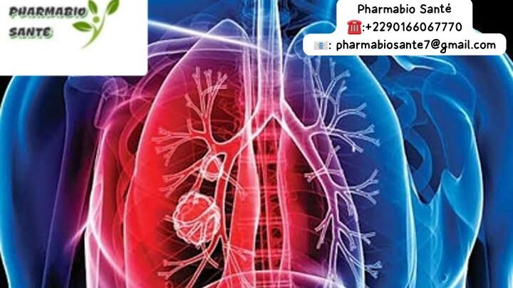 Tuberculose pulmonaire Solution naturelle