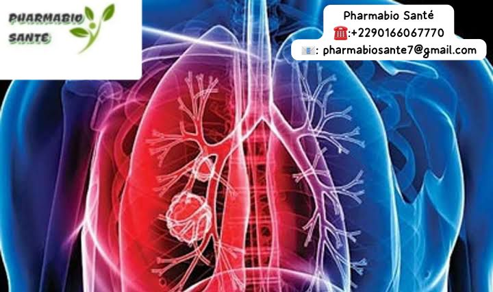 Tuberculose pulmonaire Solution naturelle