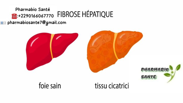 Fibrose Hépatique Traitements Naturels