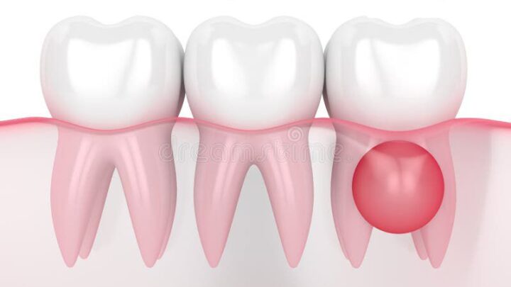 kystes dentaires remèdes naturels