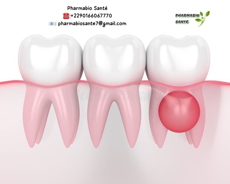 kystes dentaires remèdes naturels